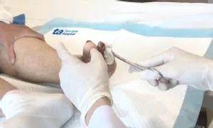 Sấy nóng chữa tiểu đường gây biến chứng hoại tử chân