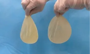Túi ngực cụ bà rách chảy silicon sau 40 năm phẫu thuật thẩm mỹ Túi ngực cụ bà rách chảy silicon sau 40 năm phẫu thuật thẩm mỹ